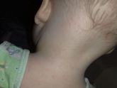Потница или аллергия???