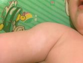 Белое пятно на ручке у ребёнка