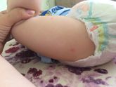 Укусы или аллергия ???