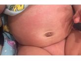 Потница??