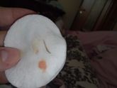 Мокрые швы спустя 1.5 месяца