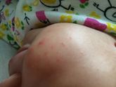 Цветение или аллергия?