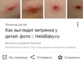 Опытные по ветрянкам🙈Это она?