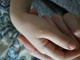 Что это может быть?прыщик будто водянистный