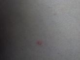 Подскажите ветрянка или нет