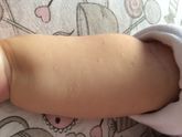 Сыпь на ручках, либо