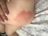 Пятно на попке у ребёнка