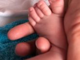 Вросший ноготь у малыша.