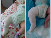 Врождённо приведённая стопа