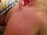 У кого на АКДС вылезала крапивница??