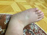 Ужасно отекли ноги( особенно