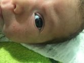 прыщи у новорожденного