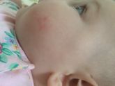 Аллергия. ??????