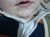 От слюни или аллергия?????