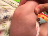 Шершавые очаги на логотках
