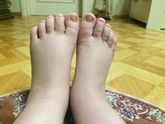 Ужасно отекли ноги( особенно