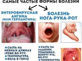 Вирус коксаки бушует в Ельце