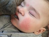 Аллергия на холод
