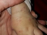 Поделитесь опытом борьбы с атопическим дерматитом! Наш результат в проце се на фото.
