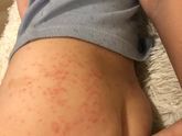Аллергия по всему телу у ребёнка. У кого была