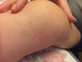 Сыпь