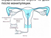 9 дпп и ХГЧ