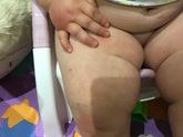 Укусы комаров