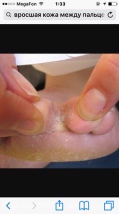Мозоль между пальцев ног