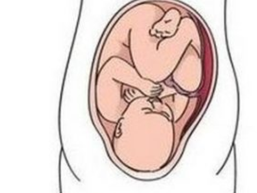 На какой недели ребенок переворачивается вниз головкой. Коленно-локтевое положение при беременности. Коленно-локтевое положение при беременности фото. Коленно локтевая позиция для беременных. Колено-локтевая поза для беременных.