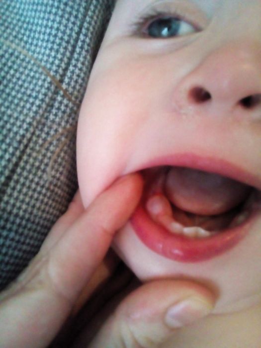 гематома прорезывания зуба