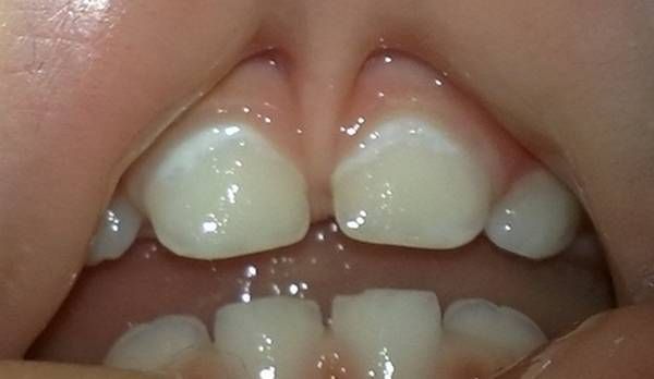 Белое пятно на зубе, у ребенка.