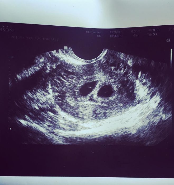 6 недель,эмбрионы без сб