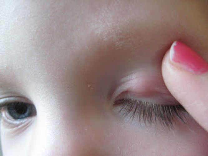 Халязион на глазу у ребенка, у кого было подобное?