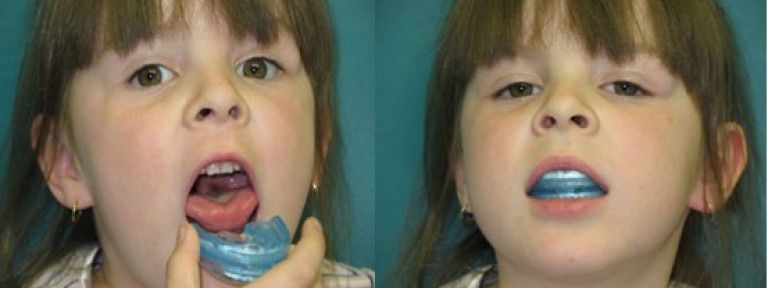 вопрос про неправильный прикус в 6 лет. кто имел дело с детскими ортодонтами??