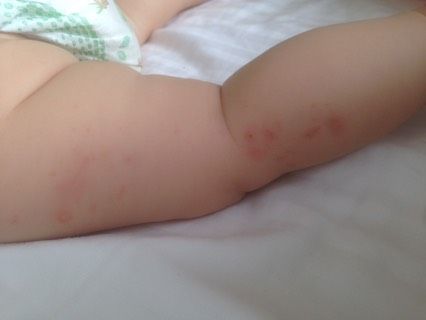 Малышку покупали комары ,
