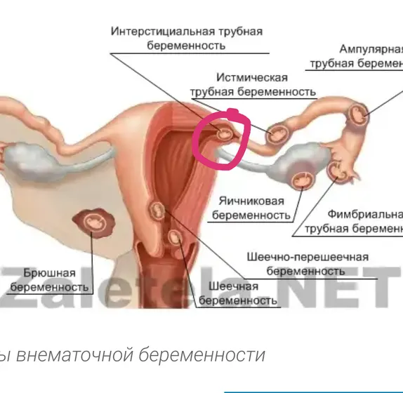 ВБ в углу матки??