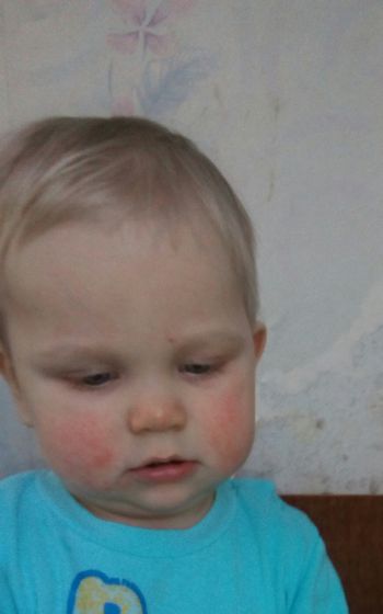 Аллергия.