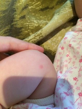 Сыпь у ребенка