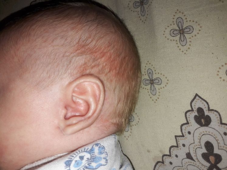 Сыпь