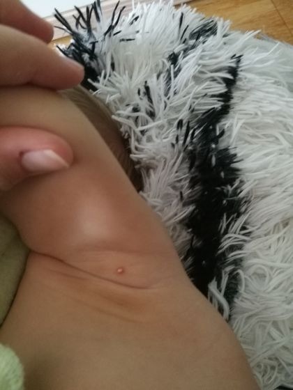 Прыщ под мышкой