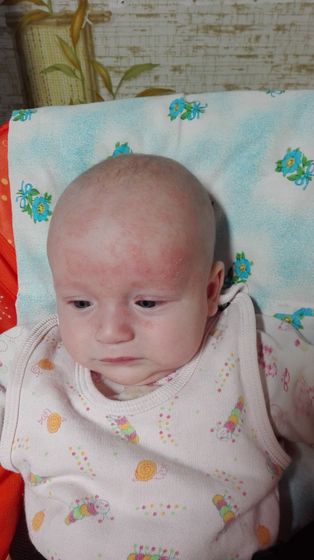 Аллергия у малыша! На что???