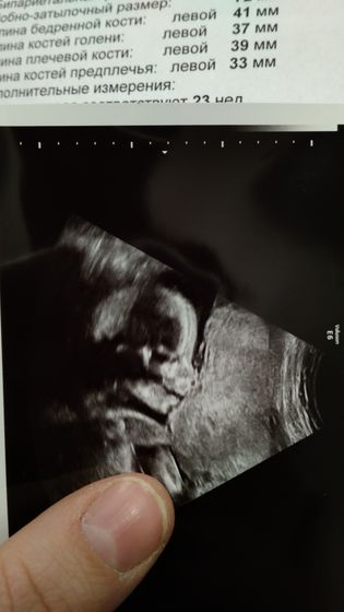 Боли при ходьбе в районе лобка с опоясывающей волной к костям таза 🙍