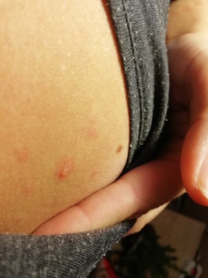 У кого была ветрянка зайдите