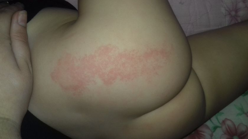 Сыпь