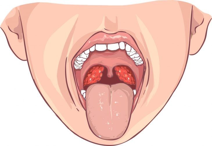 Тонзиллит👄👅