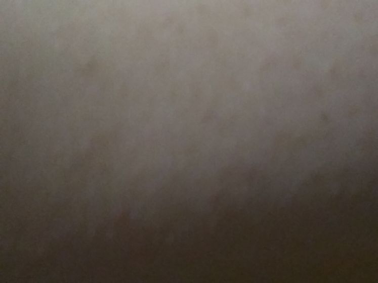 Что за сыпь?