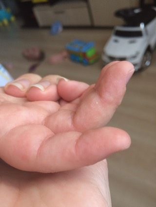 Сыпь на ладошках