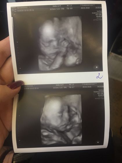Узи 24,4 недели, двойняшки👶🏻👶🏻❤️