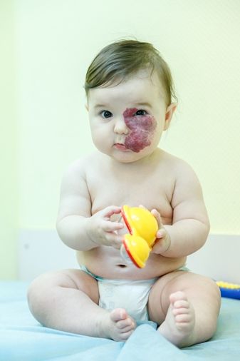 Гемангиома и вакцинация