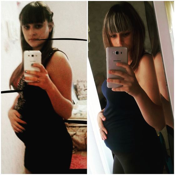 2 фото 2014 года и 2017 года срок 21 неделя